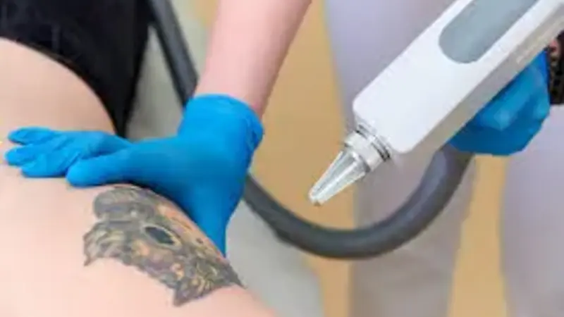 How to Choose the Right Method for Tattoo Removal